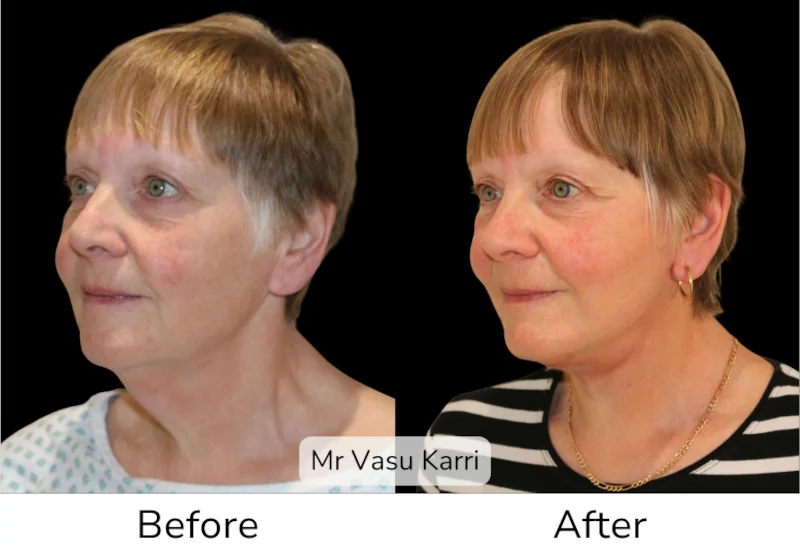 Facelift Patient 12 View 3